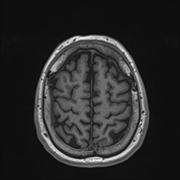 File:Cochlear incomplete partition type III associated with hypothalamic hamartoma (Radiopaedia 88756-105498 Axial T1 160).jpg