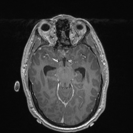 File:Colloid cyst (Radiopaedia 44510-48181 Axial T1 C+ 76).png