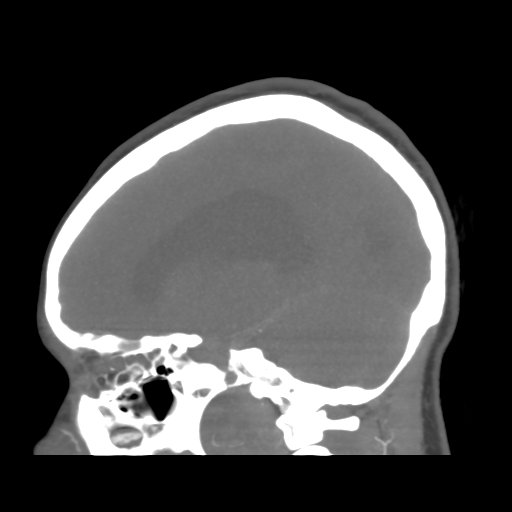 File:Colloid cyst (resulting in death) (Radiopaedia 33423-34499 B 23).png