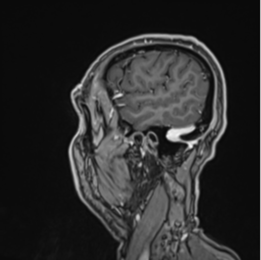 File:Colloid cyst of the third ventricle (Radiopaedia 86571-102662 Sagittal T1 C+ 66).png