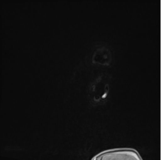 File:Colloid cyst of the third ventricle (Radiopaedia 86571-102662 Sagittal T1 C+ 80).png