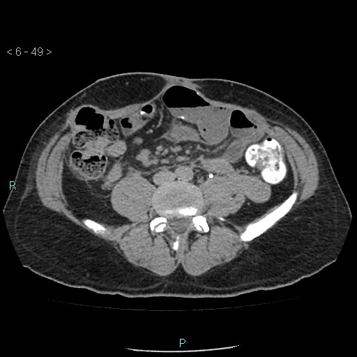 Colo-cutaneous fistula (Radiopaedia 40531-43129 A 20).jpg