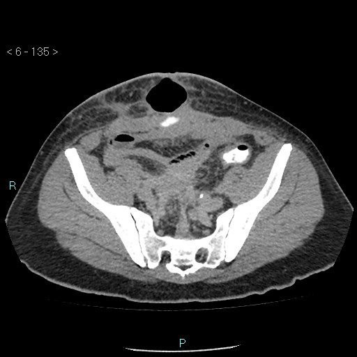 File:Colo-cutaneous fistula (Radiopaedia 40531-43129 A 56).jpg