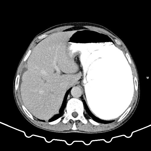 File:Colocolic intussusception due to large lipoma (Radiopaedia 68773-78482 A 26).jpg