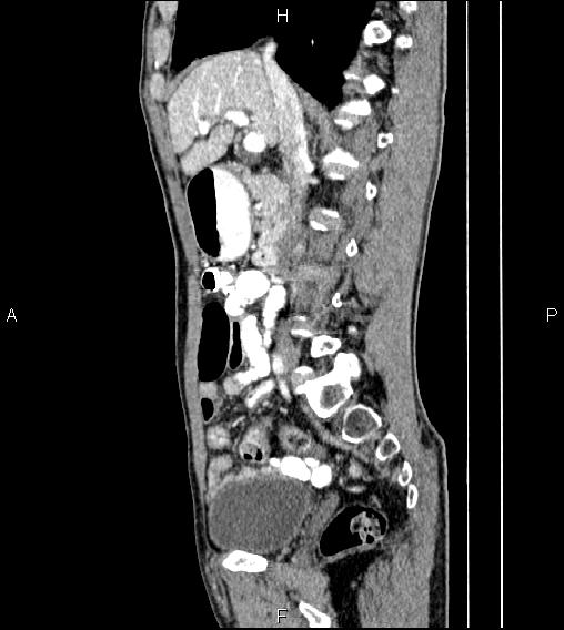 Colon adenocarcinoma - hepatic flexure (Radiopaedia 85635-101395 D 36).jpg
