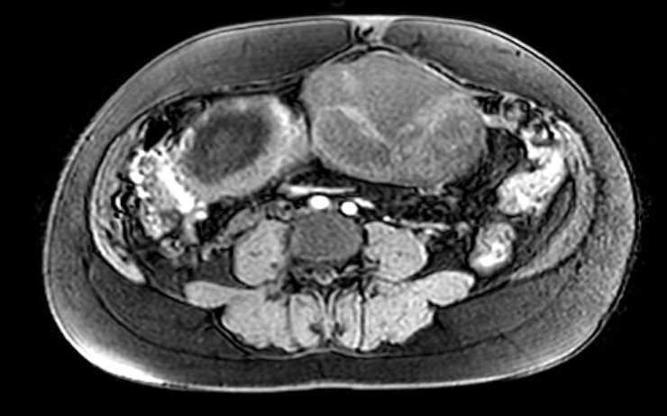 Colon adenocarcinoma with Krukenberg tumors, advanced pregnancy (Radiopaedia 67279-76645 A 38).jpg