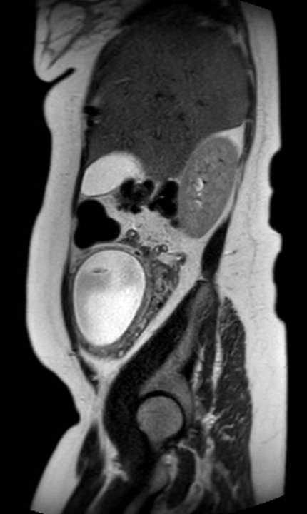 Colon adenocarcinoma with Krukenberg tumors, advanced pregnancy (Radiopaedia 67279-76645 Sagittal T2 39).jpg