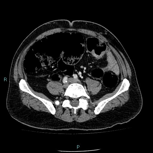 Colon adenocarcinoma with calcific liver metastasis (Radiopaedia 55745-62300 B 30).jpg