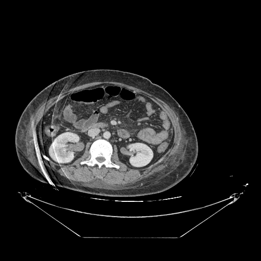 Colonic infarction after colostomy creation (Radiopaedia 81157-94797 A 79).jpg