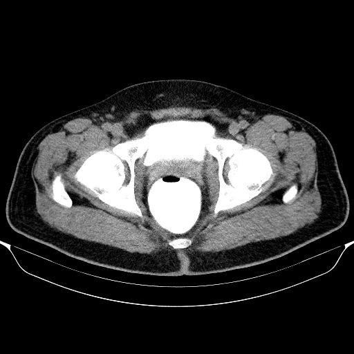 Colonic lipoma with colo-colic intussusception (Radiopaedia 58944-66200 Axial C+ rectal 71).jpg