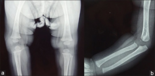 Wimberger corner sign; X-rays of (a) lower limbs (AP view) and (b) upper limbs (AP view) showing resolution of metaphyseal erosions and periosteal reaction