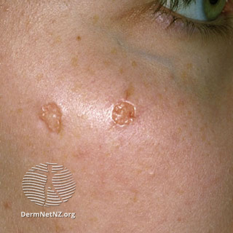 File:Desmoplastic trichoepithelioma (DermNet NZ lesions-s-tricho2).jpg