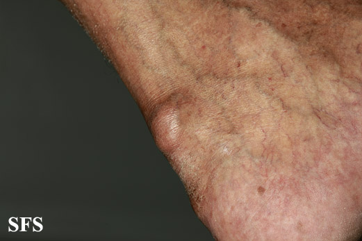 File:Gout (Dermatology Atlas 5).jpg