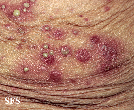 File:Impetigo (Dermatology Atlas 54).jpg