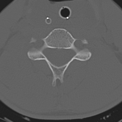 File:Multitrauma with diffuse axonal injury, temporal bone fractures and traumatic caroticocavernous fistula (Radiopaedia 37242-39035 Axial 168).png