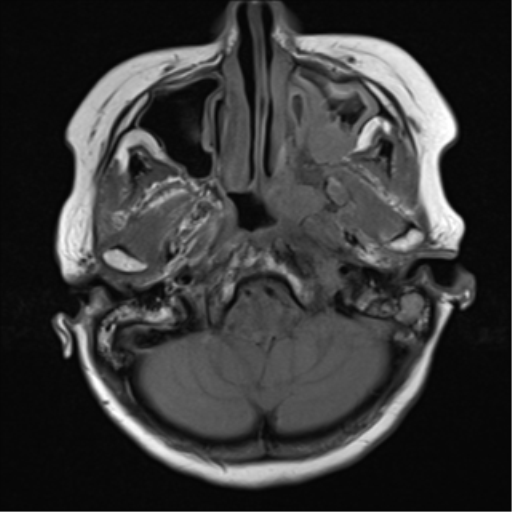 File:Nasopharyngeal carcinoma with cerebral abscess (Radiopaedia 43018-46273 Axial T1 17).png