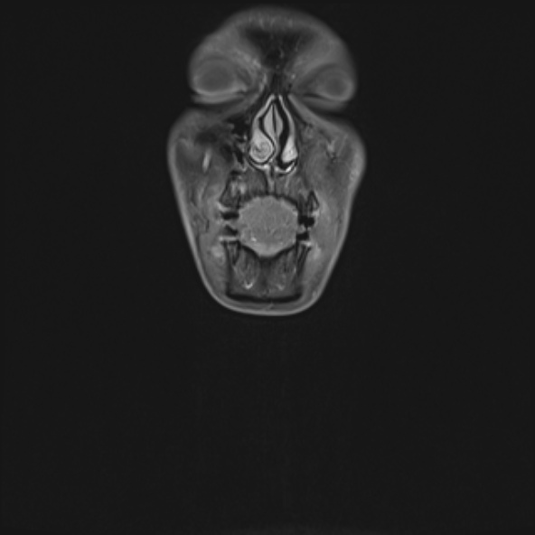 Nasopharyngeal carcinoma with skull base invasion (Radiopaedia 53415-59485 E 40).jpg