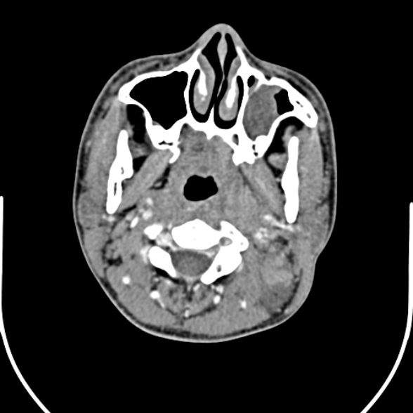 File:Nasopharyngeal carcinoma with skull base invasion (Radiopaedia 53415-59705 A 70).jpg