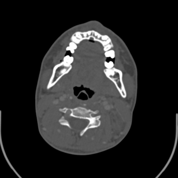 Nasopharyngeal carcinoma with skull base invasion (Radiopaedia 53415-59705 Axial bone window 105).jpg