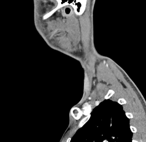 Nasopharyngeal carcinoma with skull base invasion (Radiopaedia 53415-59705 C 6).jpg