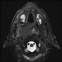 File:Nasopharyngeal carcinoma with skull base invasion (Radiopaedia 59258-66600 D 24).jpg