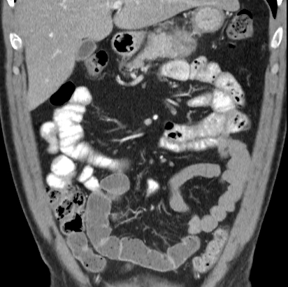 File:Necrotizing pancreatitis with acute necrotic collection (Radiopaedia 14470-14417 C 10).jpg