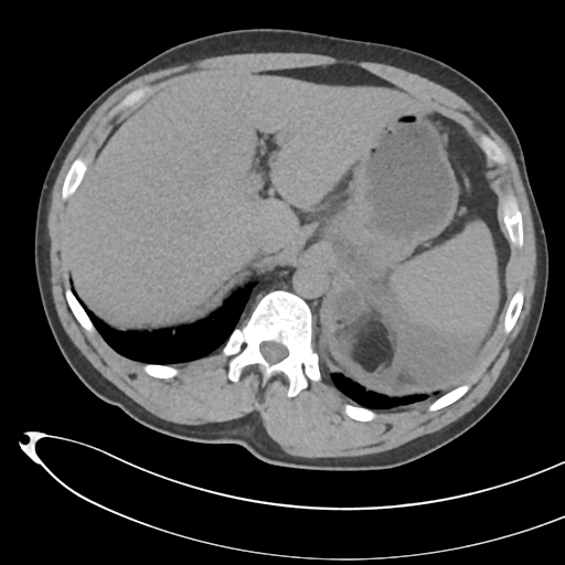 File:Necrotizing pancreatitis with acute necrotic collections (Radiopaedia 38829-41012 Axial non-contrast 19).png