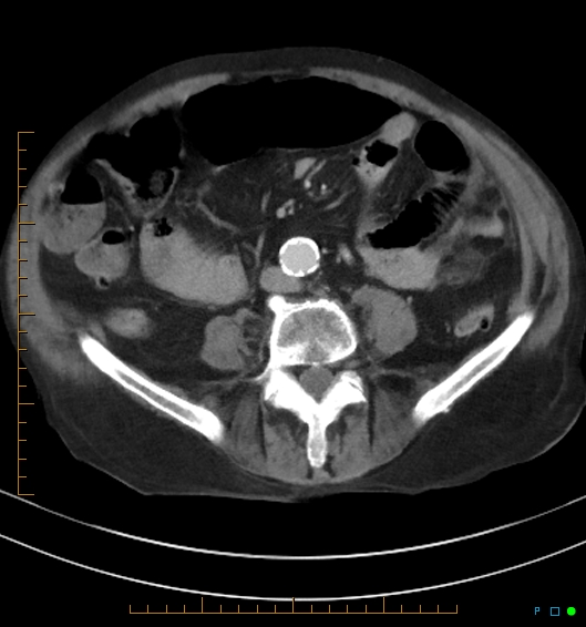 Necrotzing fasciitis due to a perforated adenocarcinoma of the splenic flexure (Radiopaedia 46930-51455 A 40).jpg