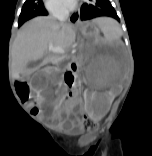 Nephroblastomatosis (Radiopaedia 71294-81607 B 180).jpg