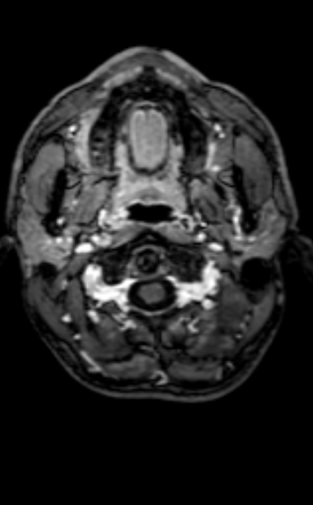 Neuro-Behçet disease (Radiopaedia 90112-107294 Axial T1 C+ 205).jpg