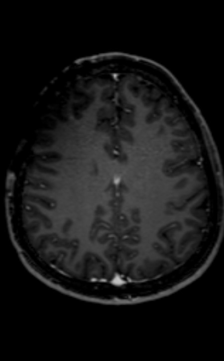 Neuro-Behçet disease (Radiopaedia 90112-107294 Axial T1 C+ 96).jpg