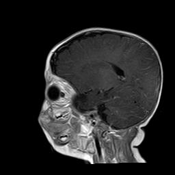 File:Neurofibromatosis type 1 (Radiopaedia 30089-30671 Sagittal T1 C+ 13).jpg