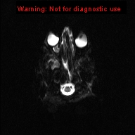 File:Neurofibromatosis type 1 with optic nerve glioma (Radiopaedia 16288-15965 Axial DWI 20).jpg