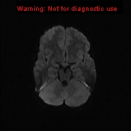 File:Neurofibromatosis type 1 with optic nerve glioma (Radiopaedia 16288-15965 Axial DWI 63).jpg