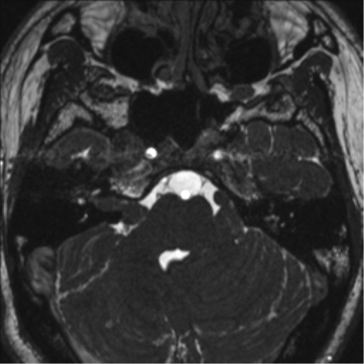 Neurofibromatosis type 2 (Radiopaedia 44936-48838 E 32).png
