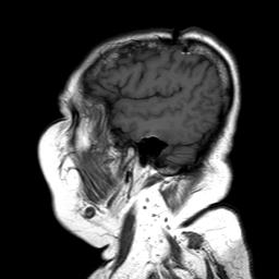 File:Neurofibromatosis type 2 (Radiopaedia 8713-9518 Sagittal T1 17).jpg
