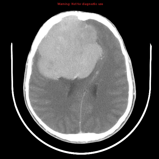 File:Neurofibromatosis type 2 (Radiopaedia 8953-9732 C 22).jpg