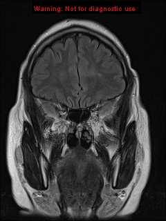 File:Neuroglial cyst (Radiopaedia 10713-11184 Coronal FLAIR 19).jpg