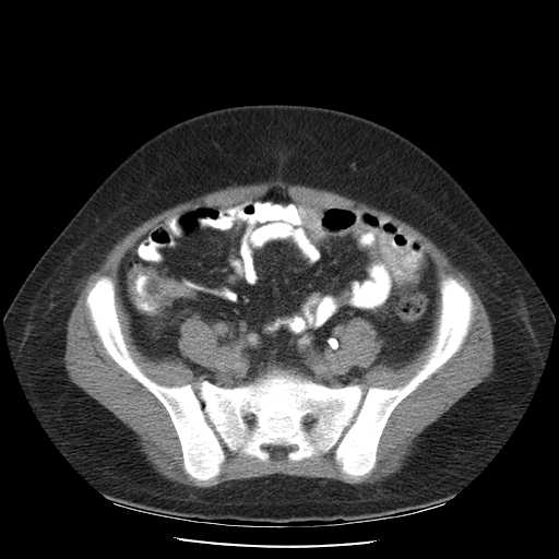 File:Non-Hodgkin lymphoma involving pelvis (Radiopaedia 21281-21197 B 47).jpg