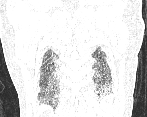 Non-specific interstitial pneumonia (NSIP) (Radiopaedia 68599-78228 Coronal lung window 92).jpg