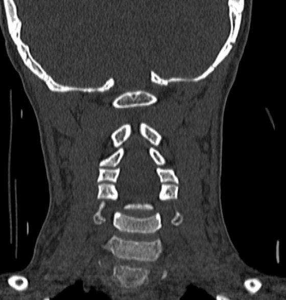 File:Normal CT cervical spine - 12-year-old (Radiopaedia 55352-61775 Coronal bone window 129).jpg