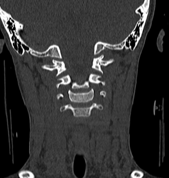 File:Normal CT cervical spine - 12-year-old (Radiopaedia 55352-61775 Coronal bone window 85).jpg