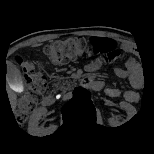 File:Normal CT intravenous cholangiogram (Radiopaedia 38199-40208 Axial IVC (MIP) 16).png