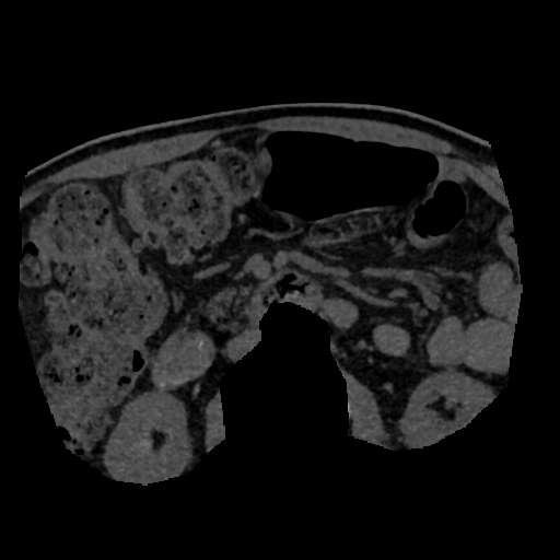 File:Normal CT intravenous cholangiogram (Radiopaedia 38199-40208 Axial IVC (MIP) 3).png