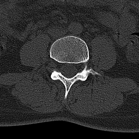File:Normal CT lumbar spine (Radiopaedia 53981-60118 Axial bone window 48).jpg