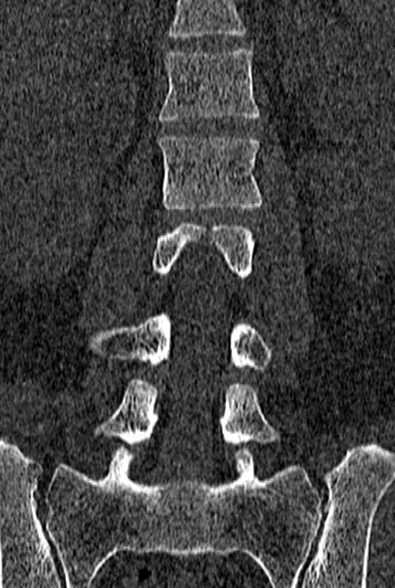 Normal CT lumbar spine (Radiopaedia 53981-60118 Coronal bone window 33).jpg