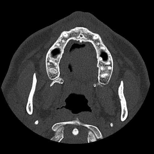 Normal CT paranasal sinuses (Radiopaedia 42286-45390 Axial bone window 98).jpg
