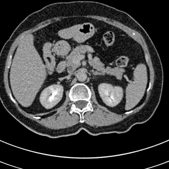 File:Normal CT split bolus study of the renal tract (Radiopaedia 48631-53634 Axial split bolus 44).jpg