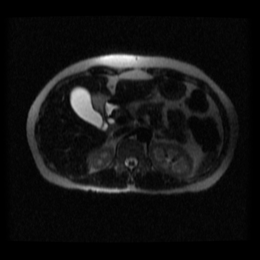 File:Normal MRCP (Radiopaedia 41966-44978 Axial T2 thins 20).png