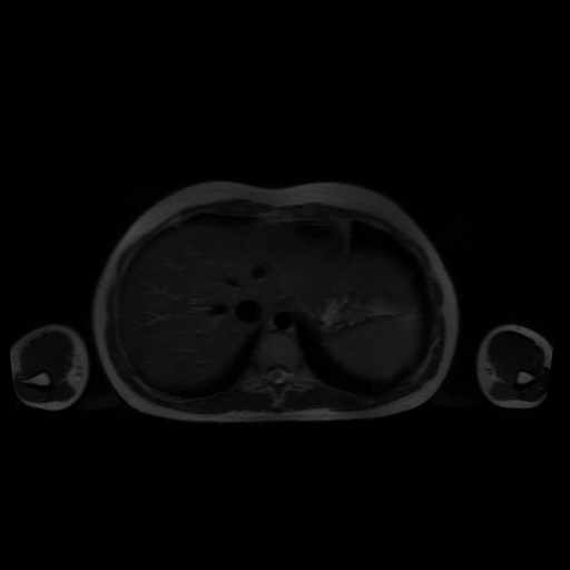 File:Normal MRI abdomen in pregnancy (Radiopaedia 88001-104541 Axial T2 6).jpg